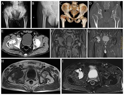 Treatment of gorham-stout disease with bisphosphonates and total hip arthroplasty: A case report